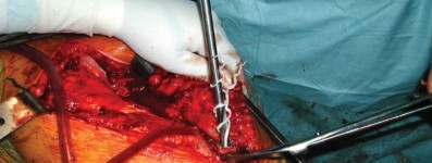 Illustration 82 for S-ROM: Inside the Technique of Modular Implant Design