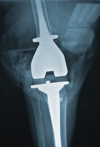 Illustration 44 for Hinged Total Knee: The Salvage Solution for Challenging Cases