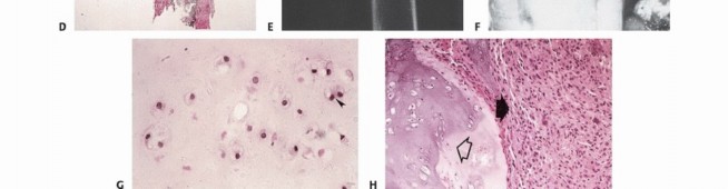 Illustration 50 for Understanding Benign Bone Tumors: Your Complete Preoperative Guide