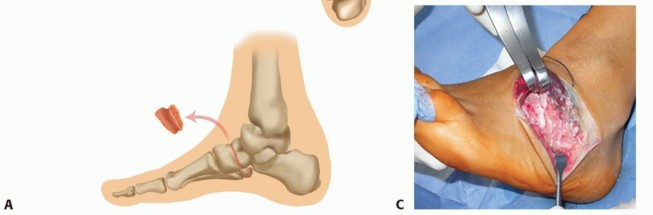 Illustration 34 for How Achilles Tendon Lengthening Fixes Equinocavovarus Foot