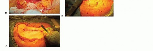Illustration 21 for Hemiarthroplasty of the Hip: Indications & Types Explained