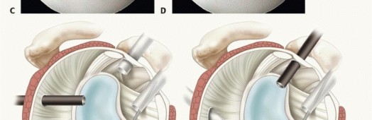 Illustration 18 for Regain Stability: Arthroscopy for Anterior Instability & the Inferior Glenohumeral Ligament