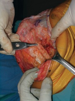 Illustration 7 for Extensor Reconstruction in Total Knee Arthroplasty: Essential Strategies