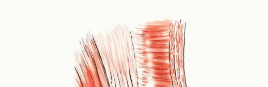 Illustration 3 for Pelvic Metastasis Surgery: A Component of the Utilitarian Approach