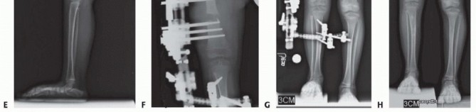 Illustration 32 for Treatment for Congenital Femoral Deficiency: What You Need to Know