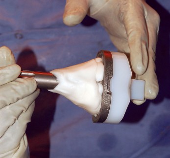 Illustration 56 for Mastering Gap Balancing in Revision TKA: Avoid Common Pitfalls