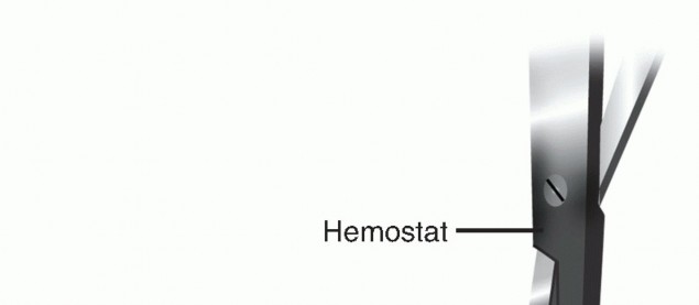Illustration 7 for Revision Lumbar Surgery: When Failed Back Syndrome Requires Reoperation