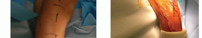 Optimizing Plate Fixation of Humeral Shaft Fractures