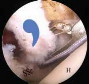 Illustration 23 for Arthroscopic Subscapularis Repair: The lo iky brady Method for Stability