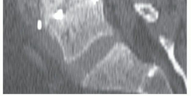 Illustration 24 for Anterior Lumbar Interbody: Fusion, Disc Replacement & Pain Relief