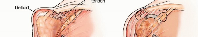 Illustration 2 for Restore Vital Function: Surgery for Type II Humeral Metastasis