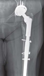 Illustration 47 for THA for patients with proximal femoral deformity: Practical solutions