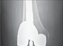 Illustration 66 for Mastering Gap Balancing in Revision TKA: Avoid Common Pitfalls