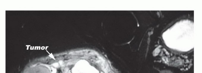 Illustration 3 for Beyond Hemipelvectomy: Preservation of the Sciatic in Buttock Surgery