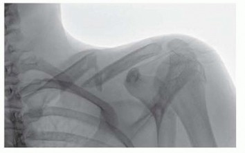 David Ring MD: Expert Insights on Clavicle Plate Fixation
