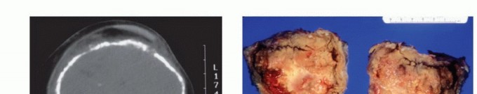 Illustration 4 for Tackling Complex Tumors of the Proximal Tibia: Limb-Sparing Solutions