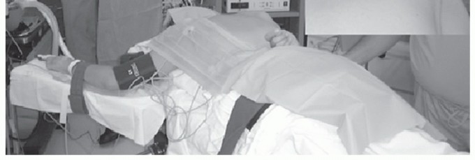 Illustration 12 for Solving Snapping Scapula: Is resection of the superomedial your option?