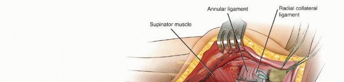 Illustration 22 for Radial Head Arthroplasty: Restoring Elbow Function & Stability