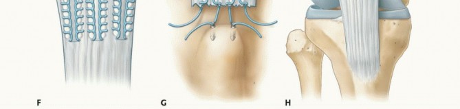 Swift Repair of Acute Patella Tendon Tears for Full Recovery
