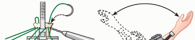 Illustration 25 for Hemiarthroplasty for Proximal: Effective Treatment for Fractures