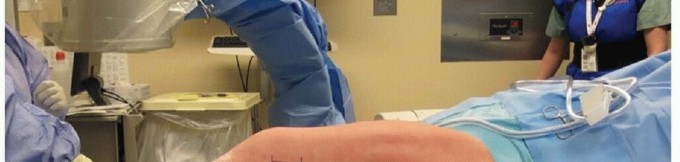 Illustration 13 for Mastering Fixation of Periprosthetic Fractures of the Femur