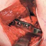 Illustration 25 for Increased Femoral Anteversion: A Proximal Femoral Rotational Osteotomy