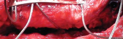 Illustration 23 for Effective Arthroplasty for Salvage of Failed Hip Fixation