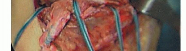 Illustration 8 for Repair & Recover from Collateral Ligament Injuries: Your Guide