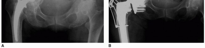 Illustration 7 for Custom Triflanged Devices: Solving Massive Acetabular Bone Loss