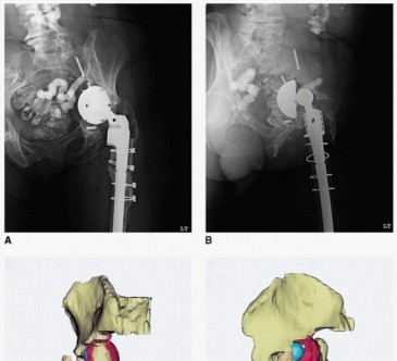 Illustration 3 for Custom Triflanged Devices: Solving Massive Acetabular Bone Loss