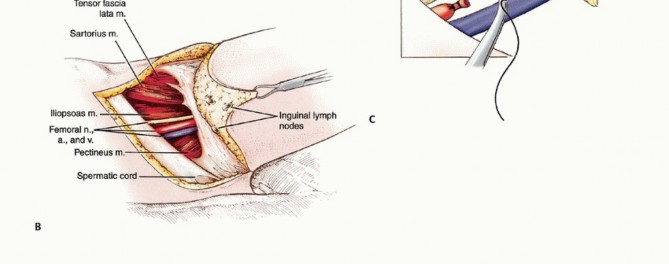 Illustration 9 for Mastering Hip Disarticulation: Through the Hip Joint Capsule