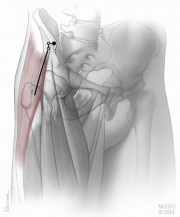 Why Anterior THA Excels: The tensor fascia lata advantage
