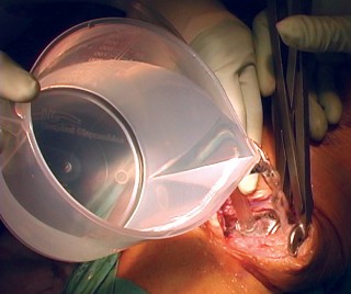 Illustration 38 for Cemented TKA Figure: Your Visual Guide to Surgical Success