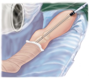 Illustration 20 for Arthrodesis with an Intramedullary Nail: Fixing Failed TKAs