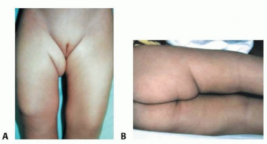 Illustration 5 for Mastering Anterior Open Reduction for Developmentally Dislocated Hip