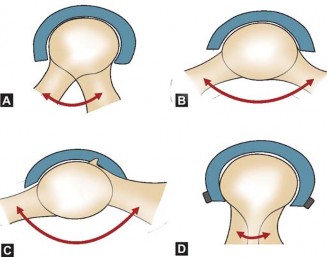Illustration 21 for Mastering Hip Arthroplasty: Its Evolution and Design Unveiled
