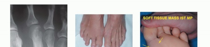 Illustration 15 for Treating Tumors of the Foot: Optimizing Amputation & Resection