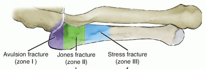 Proximal Fifth Metatarsal Fractures: Essential Surgical Strategies