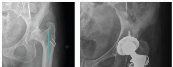 Illustration 4 for Overcoming Proximal Femoral Deformity in THA: Key Strategies