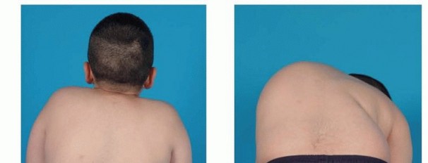 Illustration of release and fusion - Dr. Mohammed Hutaif