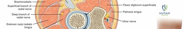 صورة توضيحية لـ خلع الولادة عند الأطفال (DDH): دليلك الشامل للعلاج والتعافي مع الأستاذ الدكتور محمد هطيف