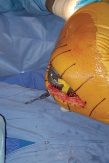 Illustration 47 for Mastering Gap Balancing in Revision TKA: Avoid Common Pitfalls