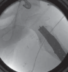 Illustration 28 for Increased Femoral Anteversion: A Proximal Femoral Rotational Osteotomy