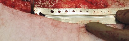 Illustration 63 for Unlock the Figure Posterior Approach to the Hip