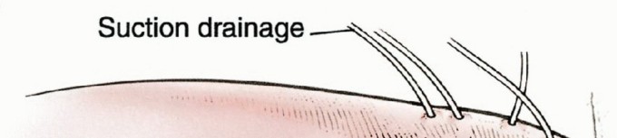 Illustration 18 for Beyond Hemipelvectomy: Preservation of the Sciatic in Buttock Surgery