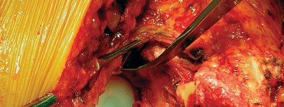 Illustration 62 for Cemented Component Longevity: The Critical Margin of the Acetabulum