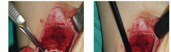 Illustration 14 for Painful Talus Lesions? The tech fig c Osteochondral Transfer Solution