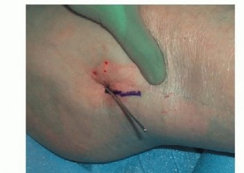 Illustration 27 for Is a Sliding Hip Screw Best for Your Femoral Neck Fracture?