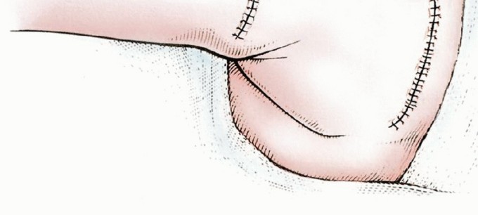 Illustration 20 for Beyond Hemipelvectomy: Preservation of the Sciatic in Buttock Surgery