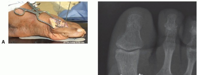 Illustration 9 for MTP Joint Arthrodesis: The Key to Optimal Toe Positioning